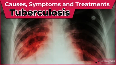 Tuberculosis article header – First Aid Course Docklands Tuberculosis article header – First Aid Article in Docklands